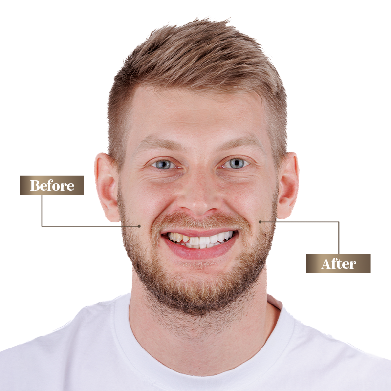 Patient with a flawless Hollywood smile after cosmetic dental treatment in Dubai