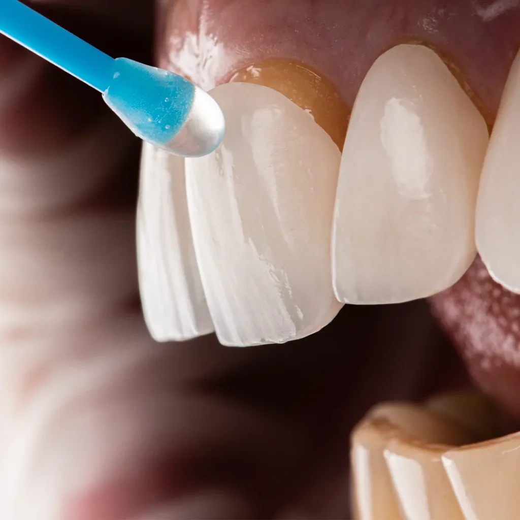 Patient smiling after dental veneers treatment in Dubai Marina clinic