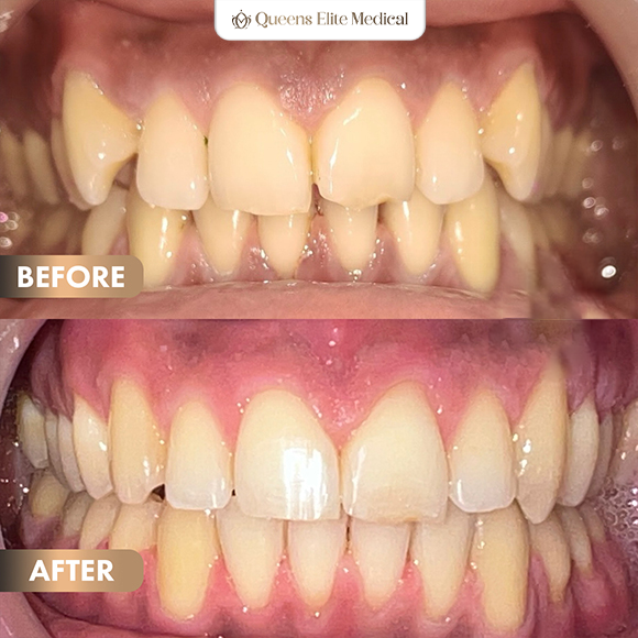 1BeforeAfter