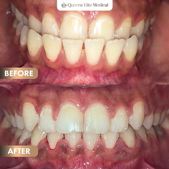 4BeforeAfter