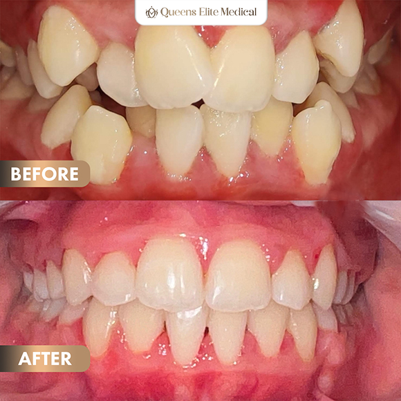 6BeforeAfter