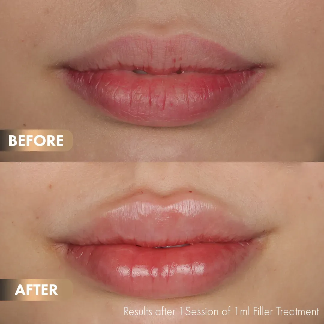 BA-Lips-1