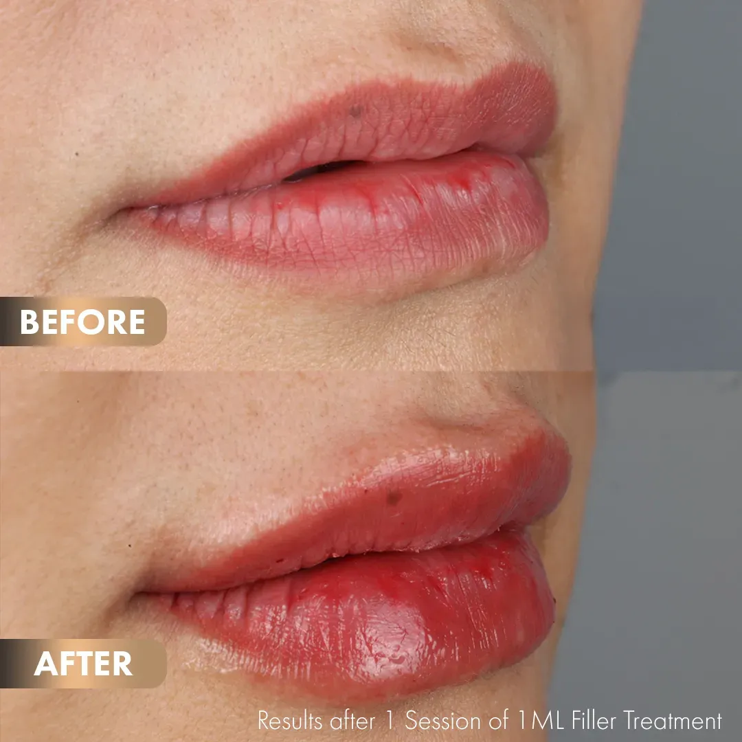 BA-Lips-2
