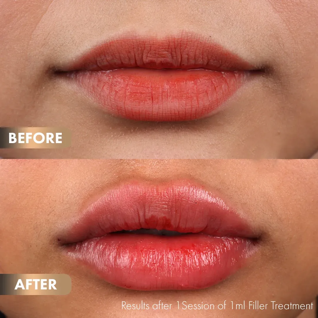 BA-Lips-4