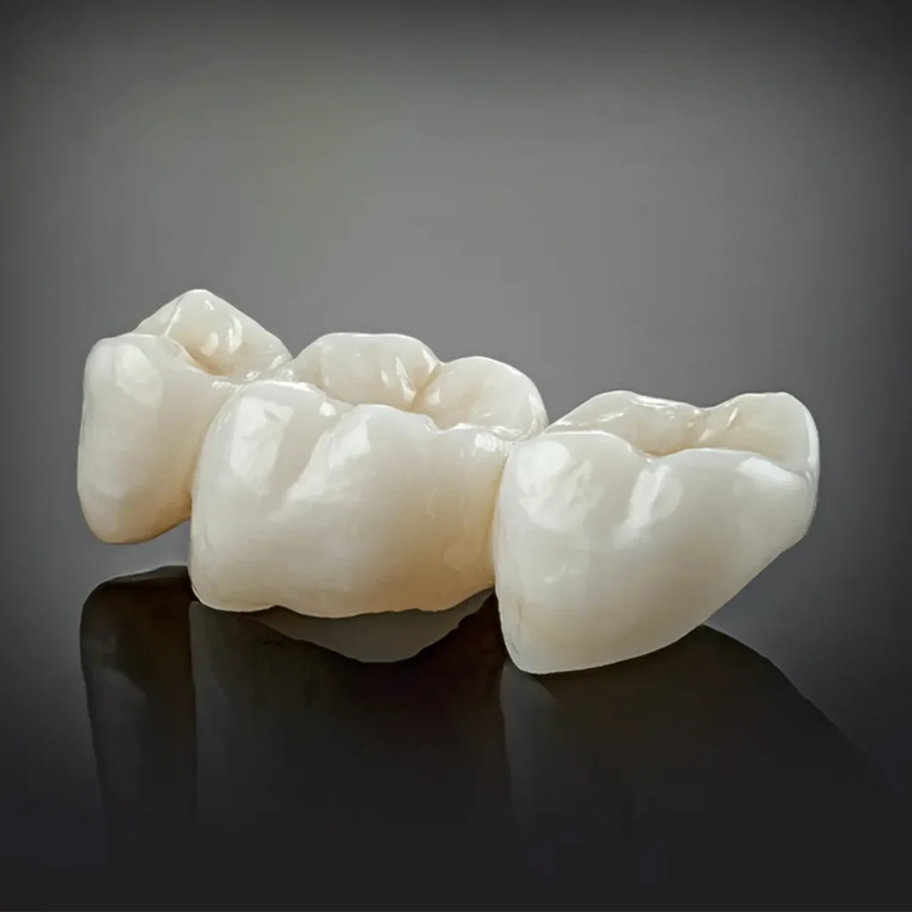 A dental bridge restoring missing teeth in a patient's mouth, representative of dental services available in Dubai.