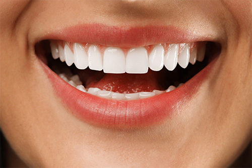 Close-up of a patient’s smile after feldspathic veneers treatment at Queens Elite Medical in Dubai