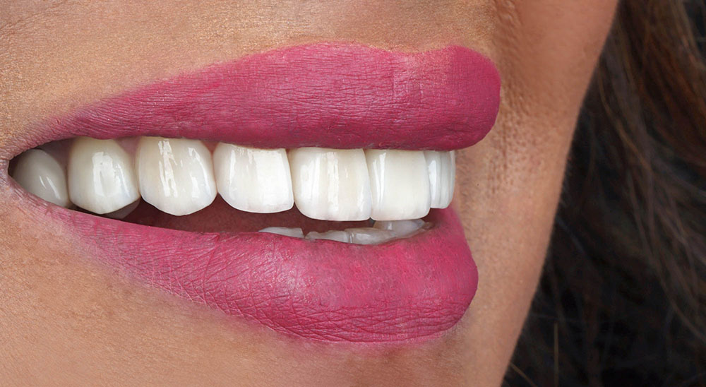 Close-up of a radiant smile enhanced with composite veneers at Queens Elite Medical, showing improved tooth shape and color. Before and after transformation of a patient's teeth using composite veneers in Dubai.