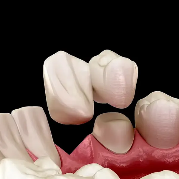 Cantilever dental bridge treatment in Dubai Marina