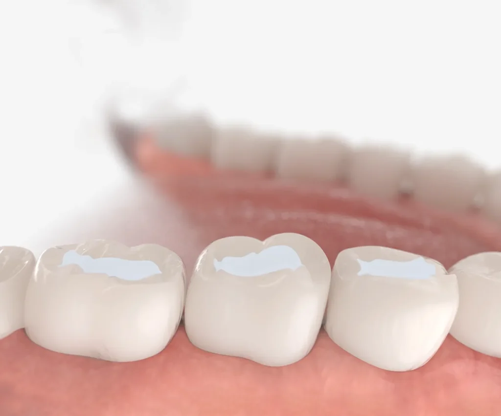 Dental sealant application to protect teeth from cavities in Dubai