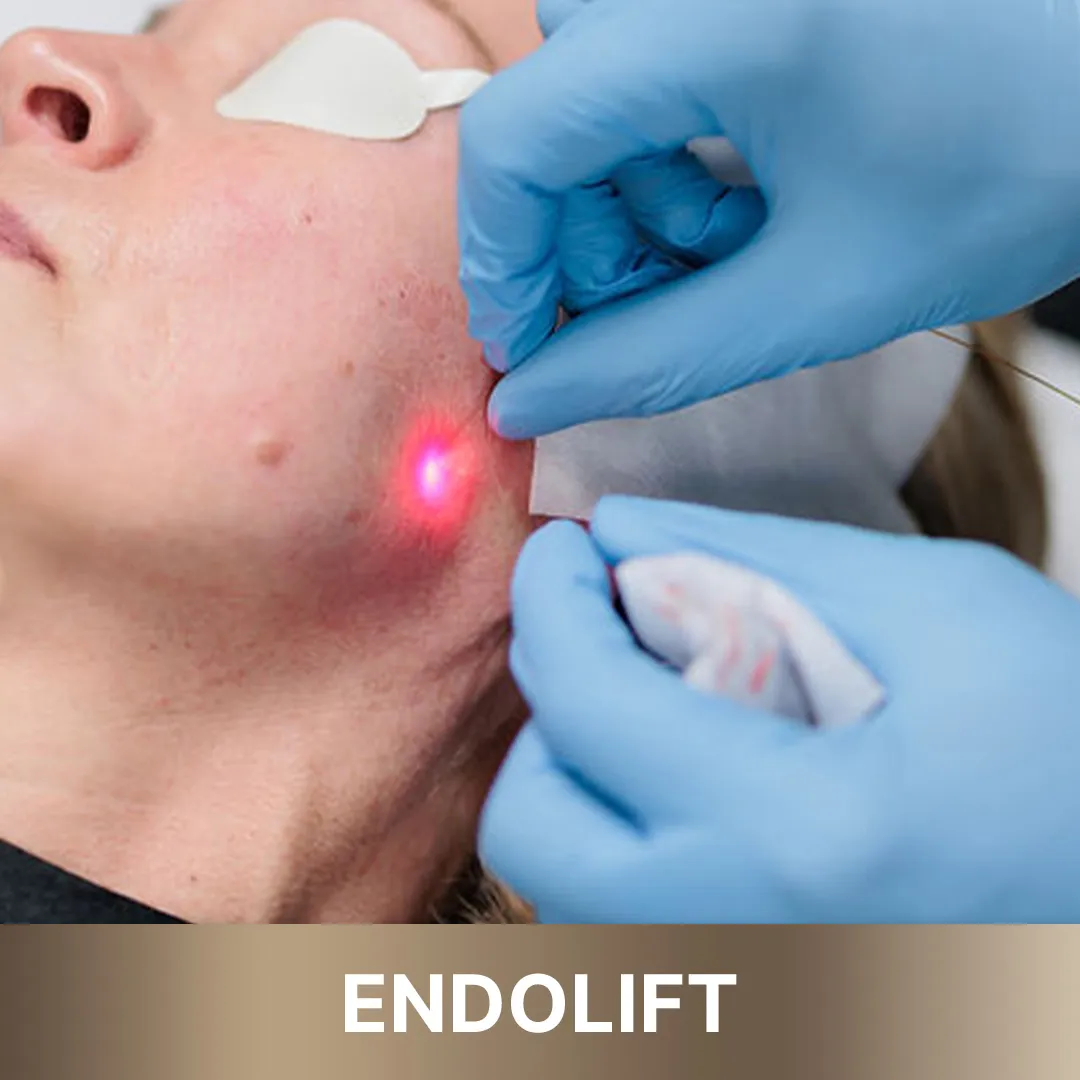 Subtle facial contouring results, indicating a successful 'Endolift' treatment from 'Queens Elite' services."
