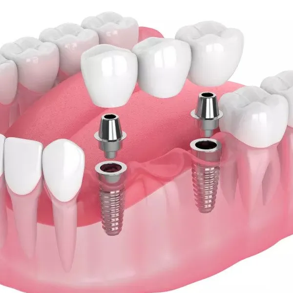 A dental implant-supported bridge filling a gap where multiple teeth are missing.