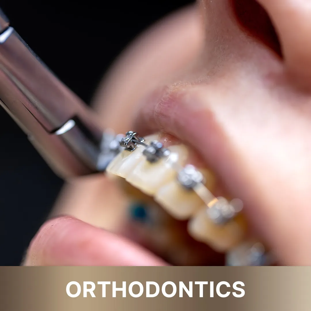 Patient smiling, showing their progress with advanced orthodontic treatment from 'Queens Elite' services.