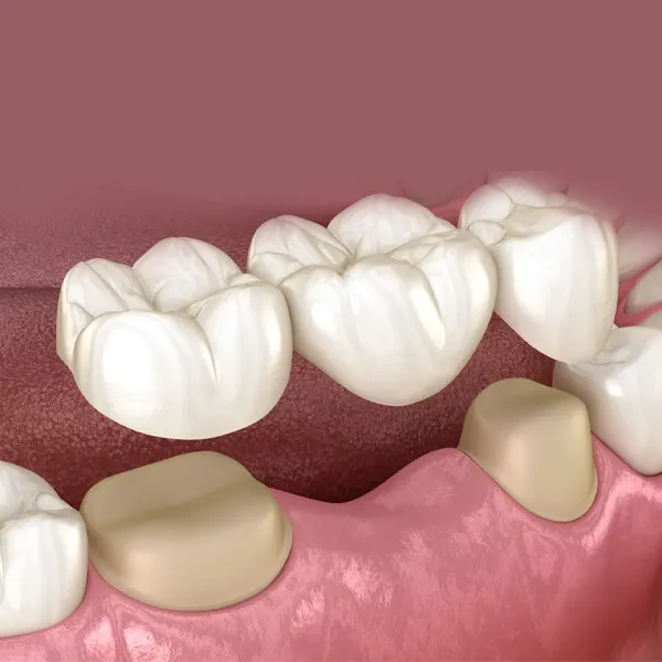 Traditional dental bridge procedure at Dubai Marina clinic
