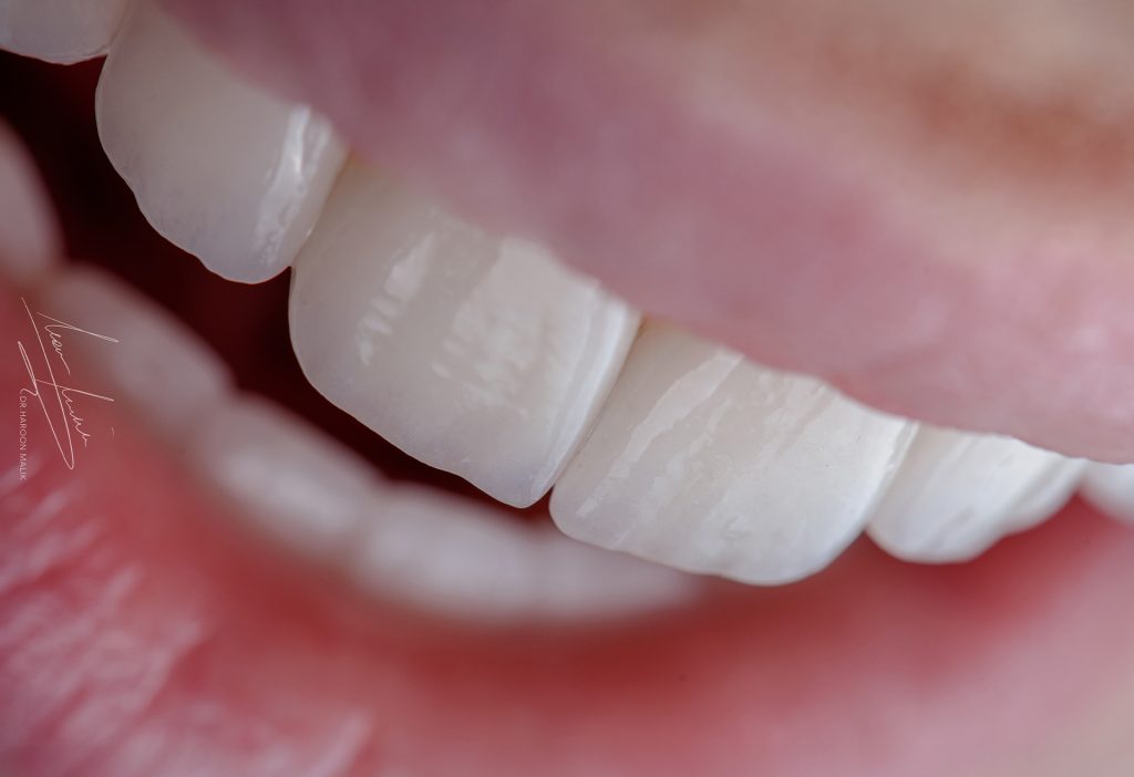 Hollywood Smile Cost in UAE – Queens Elite Medical