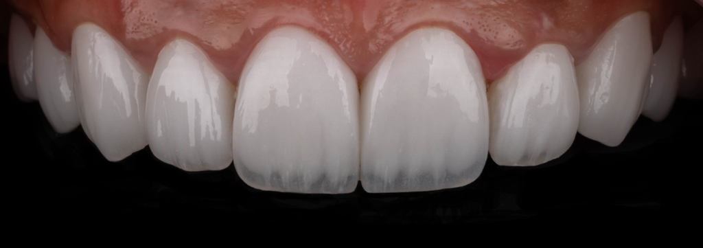 After result of feldspathic veneer dental treatment