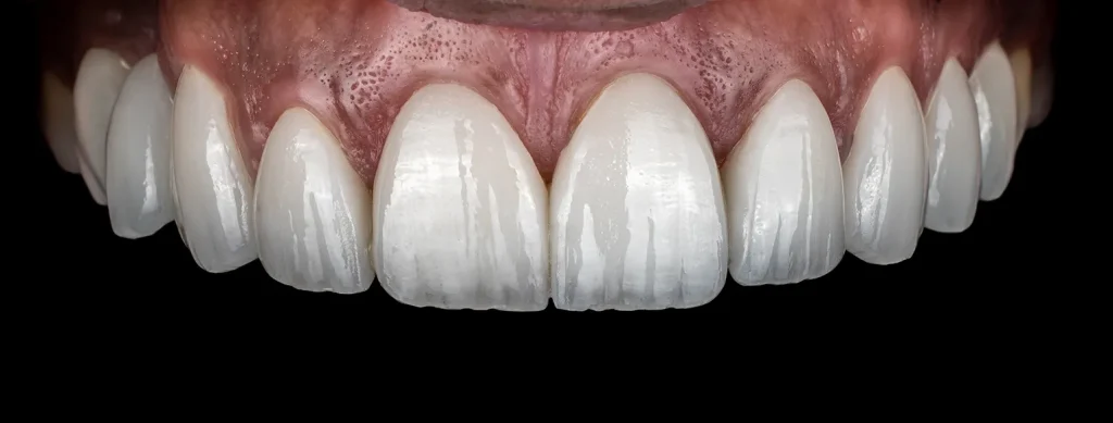 Feldspathic veneer after treatment smile result