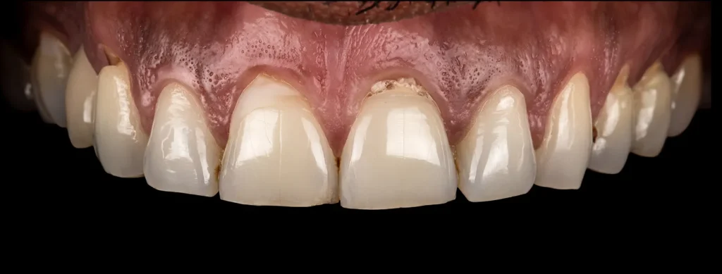 Pre-treatment image of feldspathic veneer procedure