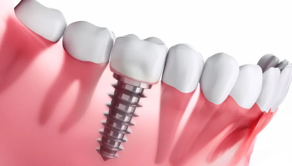 Advanced Dental Implants in Dubai