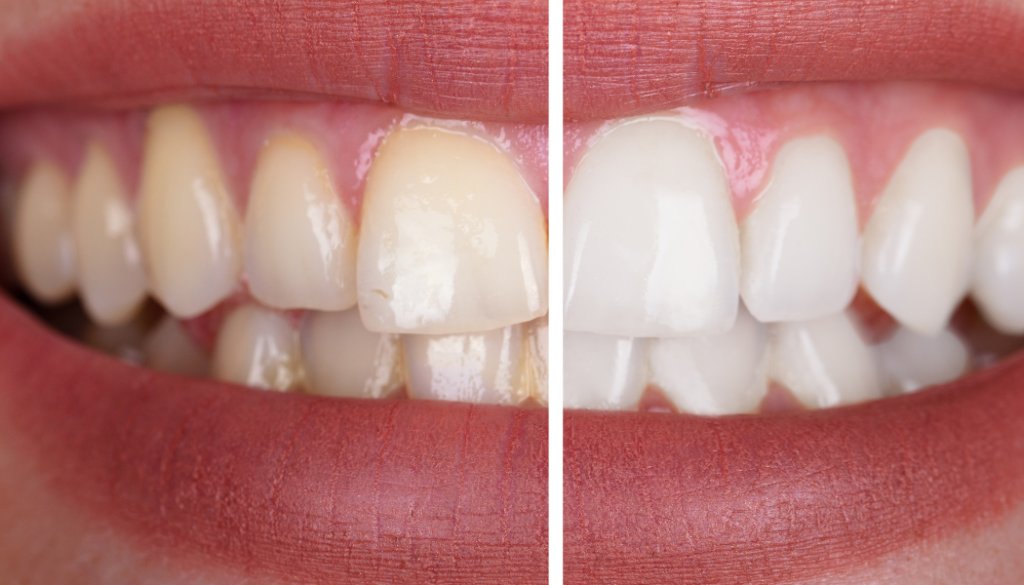 Professional Teeth Whitening in Dubai