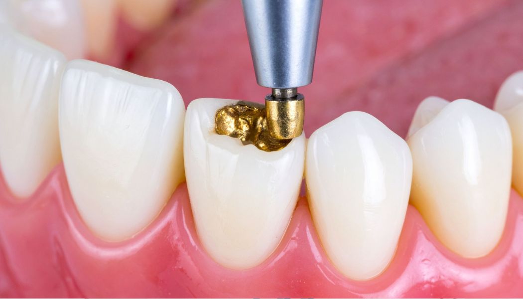 Composite Tooth Fillings