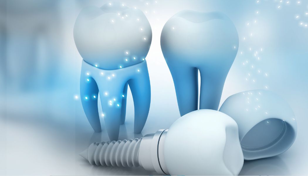 Dental Implant Cost Guide Dubai
