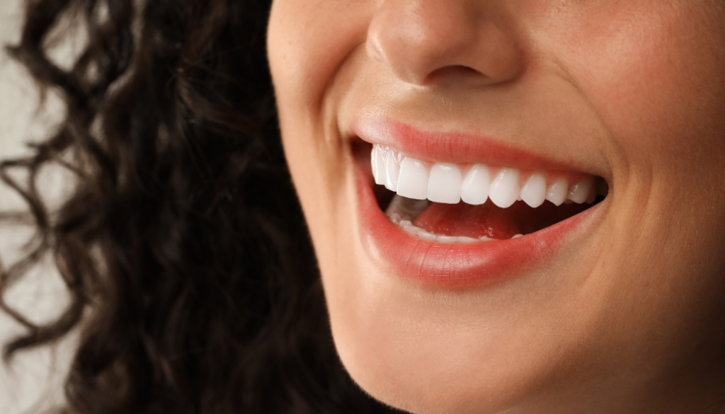Dental veneers