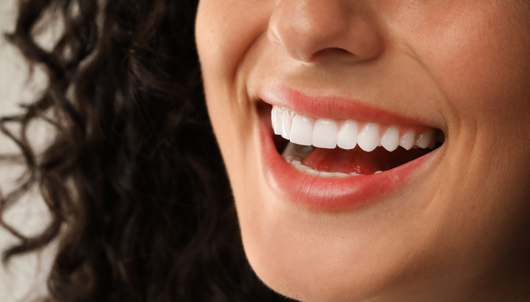 Dental veneers