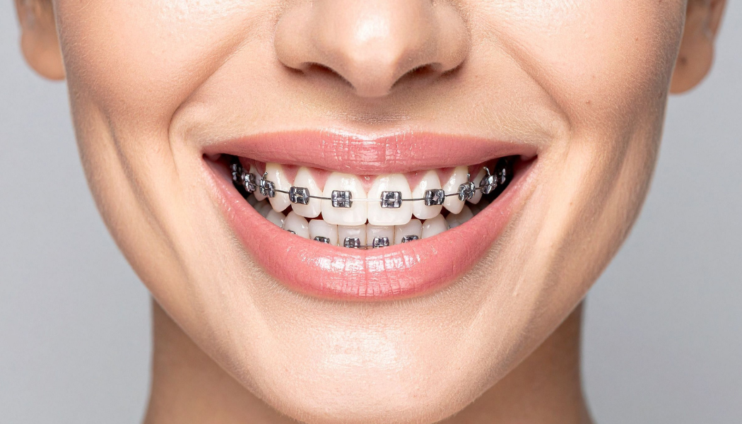 Braces in Dubai Marina