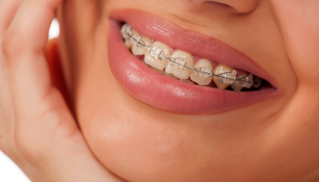 Ceramic Braces for Adults