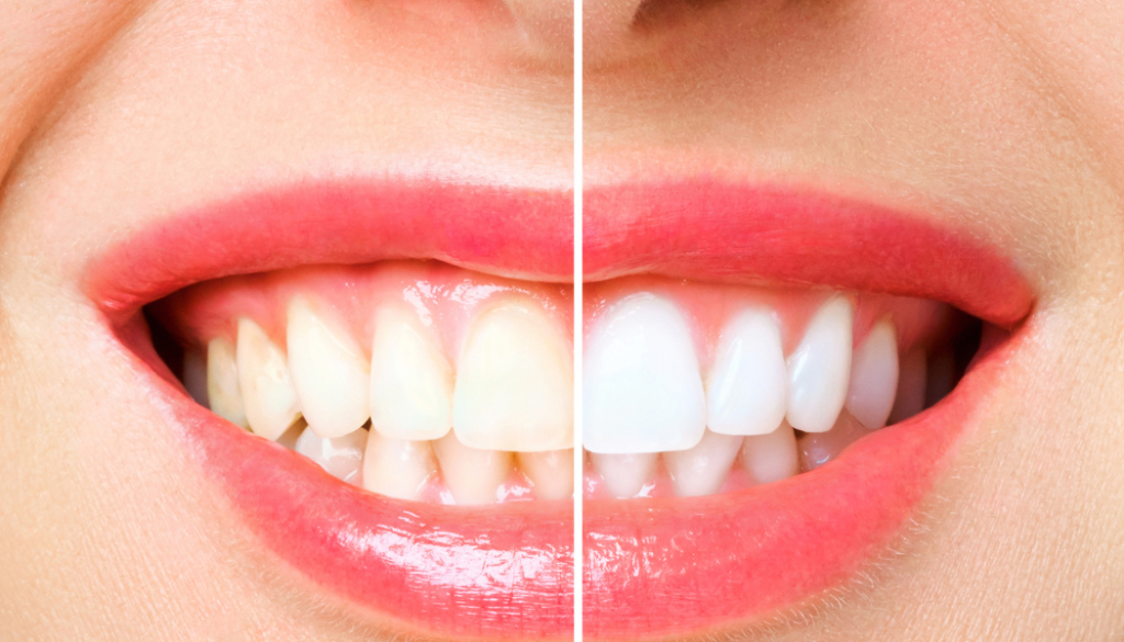 Expert Teeth Cleaning in Dubai Marina