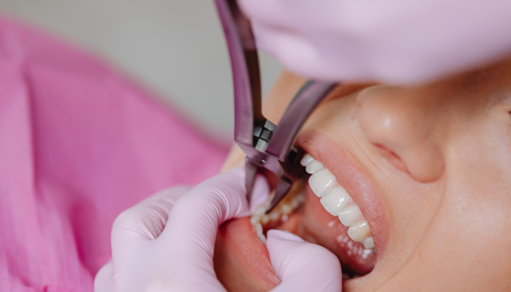 Recovery After Molar Tooth Extraction