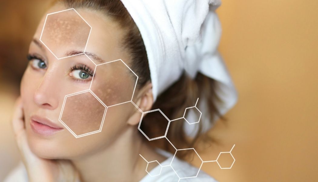Common Causes of Melasma