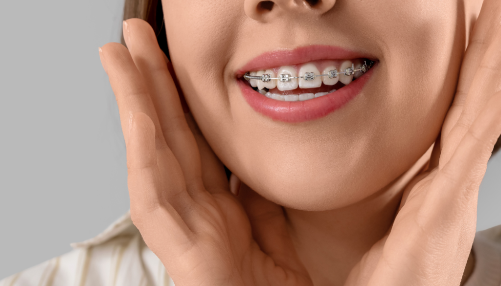 Damon Braces vs Regular Braces