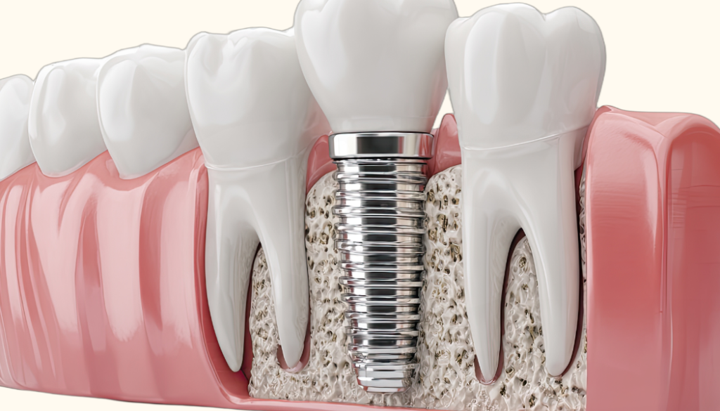 Dental Implant Becomes Loose