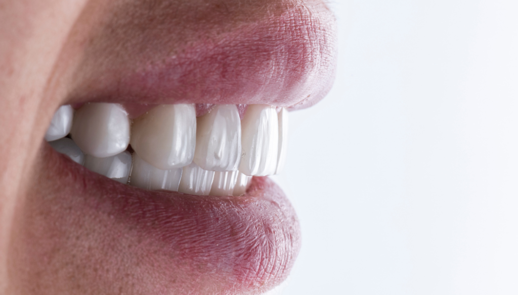 Emax Veneers for Gapped or Crooked Teeth