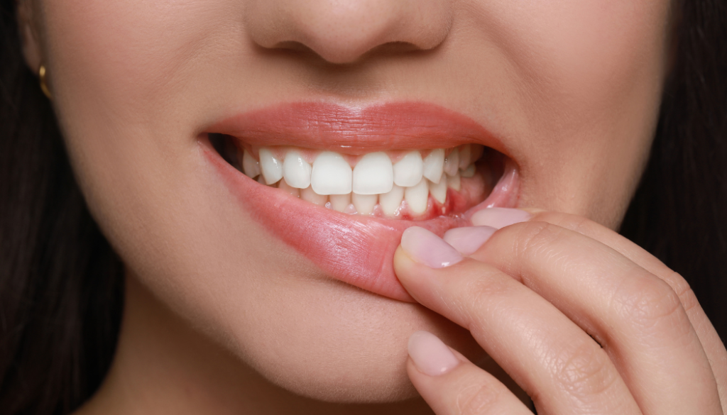 Gum Disease