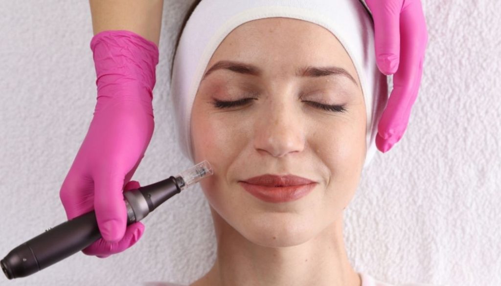 Microneedling Results