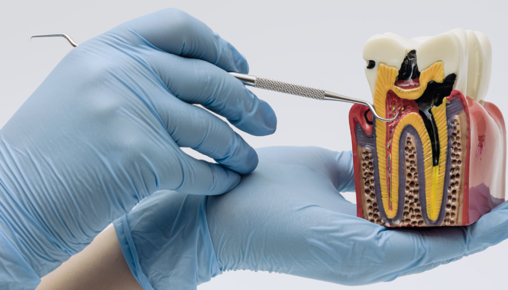 Modern Root Canal Treatment
