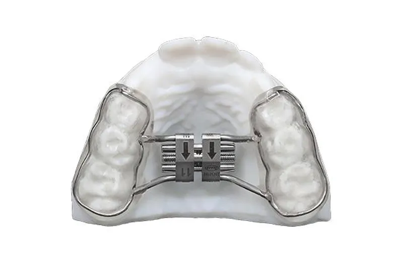 Bonded palatal expander for upper jaw expansion in Dubai
