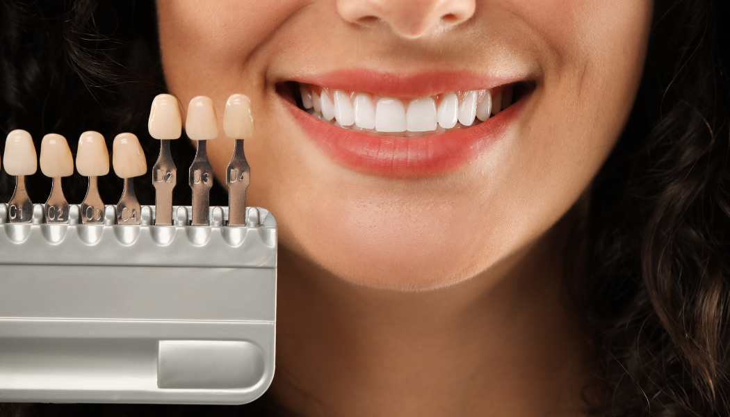 Composite Veneers Cost in Dubai