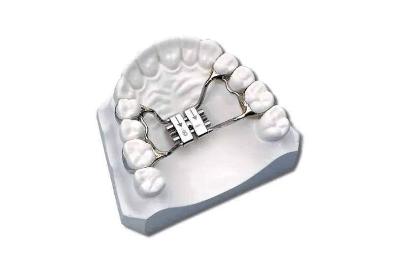 Rapid Palatal Expander (RPE) for upper jaw expansion