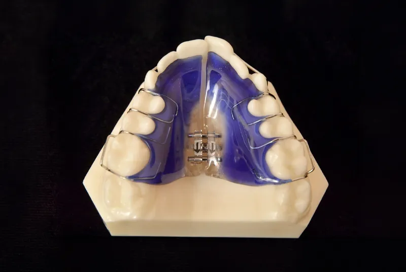 Removable palatal expander for upper jaw expansion in Dubai