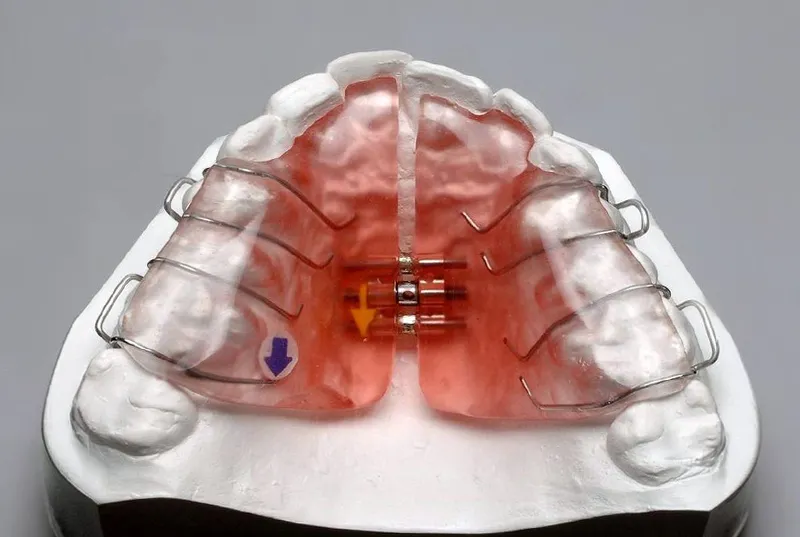Slow palatal expander for gradual upper jaw expansion